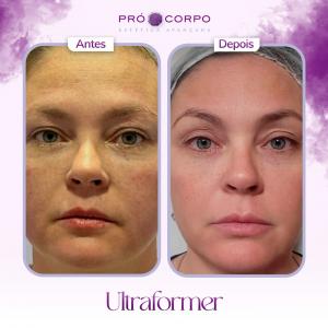 antes e depois ultraformer- ultraformer 3 - antes e depois